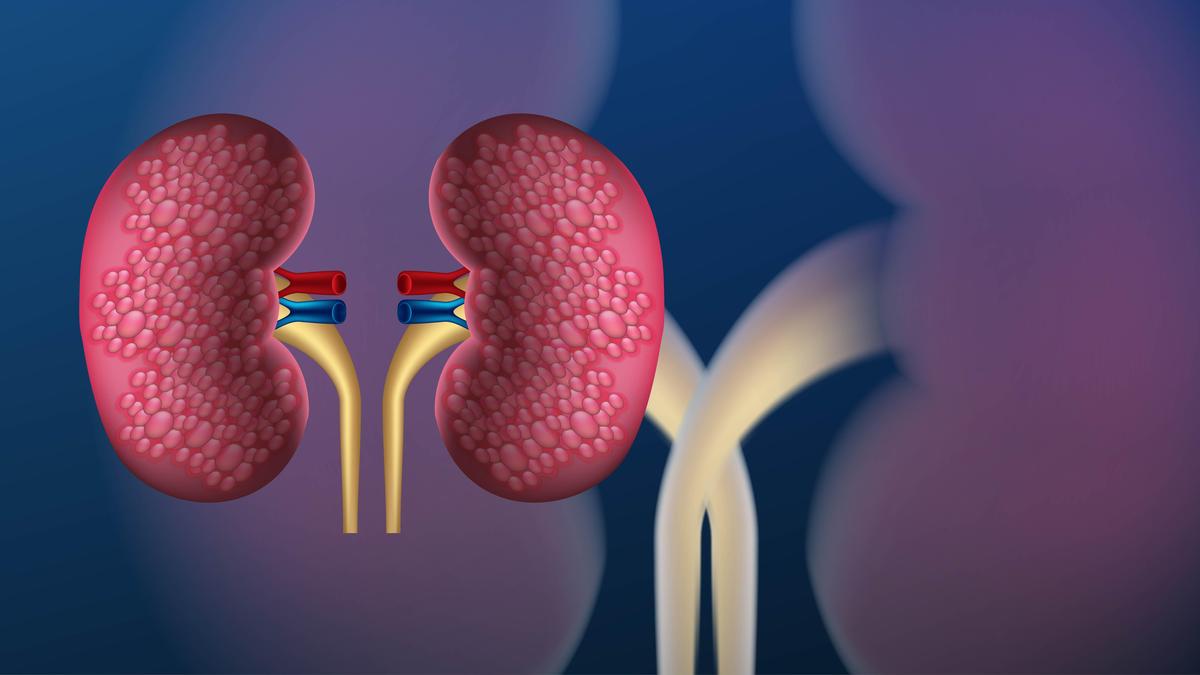 Karnataka frames guidelines for multi-pair kidney swap transplants