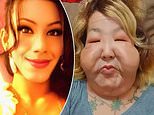 Stunning influencer who was left 'deformed' by fraudulent fillers undergoes more cosmetic surgery
